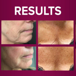 Fibroblasting Butt Lift (cellulite reduction)