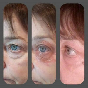 Fibroblasting Eye Area Combo (3 areas)
