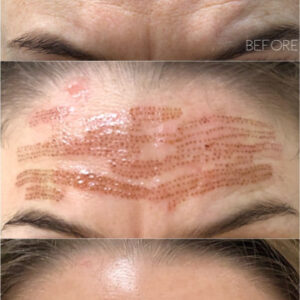 Fibroblasting Forehead Lines