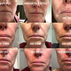 Fibroblasting Upper Lip