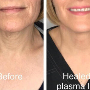 Fibroblasting Neck Lift