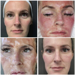 CO2 Lift Pro MicroChanneling Facial