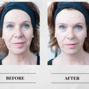 MicroDermabrasion Upgrade - Add to Any Facial